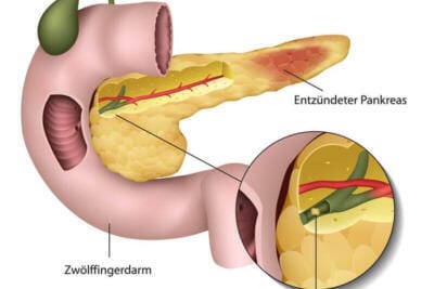 Erhöhte PankreasAmylase: Ursachen, Bedeutung und medizinische Relevanz 7 Erhöhte PankreasAmylase: Ursachen, Bedeutung und medizinische Relevanz