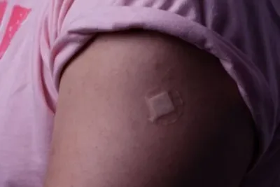 Tollwut Impfung Mensch: Kosten, Risiken und Wann Sie Die Lebensrettende Impfung Brauchen 4 "Tollwut-Impfung: Pflaster auf Oberarm nach Impfung gegen Tollwut"